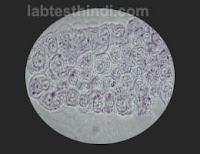 Urine Microscopic - Epi Cast