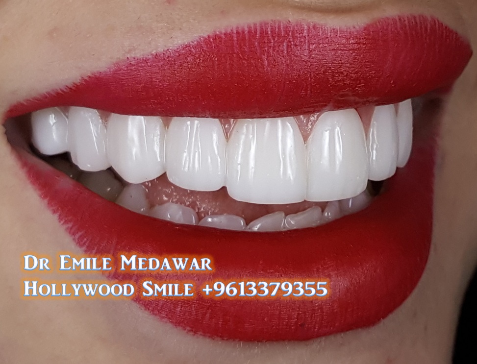 Dr Emile Medawar, Hollywood Smile, Lebanon, 00 961 3 379355 Beautiful