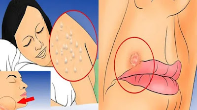 افضل مرهم لعلاج حب الثالول علاج فعال