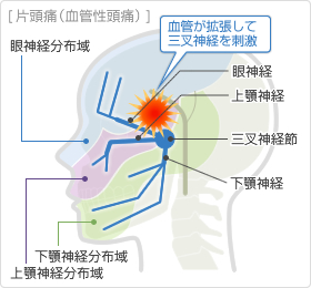 頭の片方だけが痛いとき役立つ。: 偏頭痛の特徴や見分け方