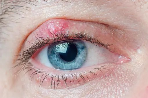 6 Blepharitis causes and causes of dermatitis around the eye Blepharitis causes