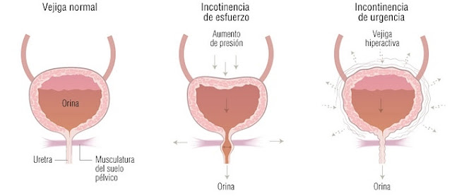 tipos-incontinencia-urinaria-mujeres