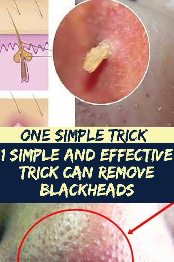 1 Simple And Effective Trick Can Remove Blackheads