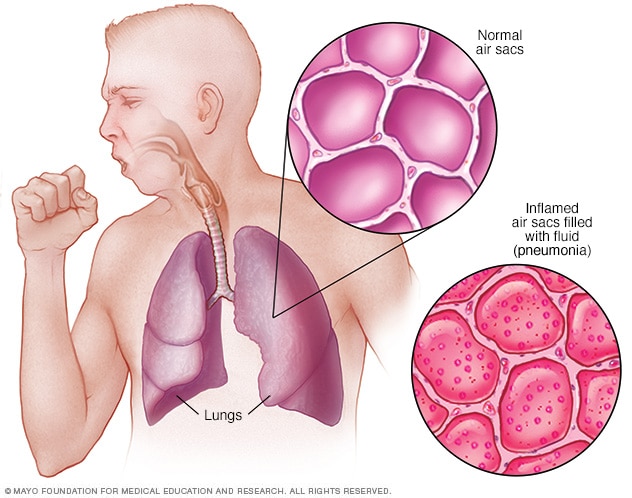 Definición enfermedad Neumonía pulmones