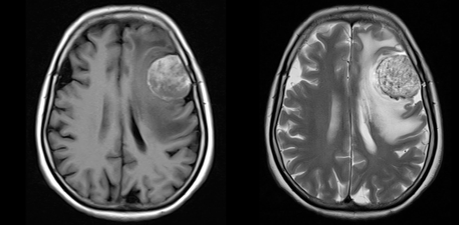 ultimate-radiology-hemorrhagic-dural-and-parenchymal-metastases-brain