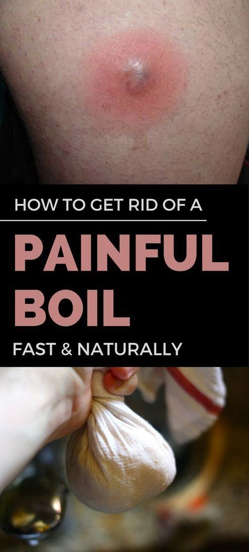 How to get rid of a boil Healthy Day 100