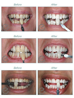 teeth whitening in Hertfordshire