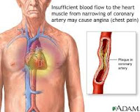 Angina pektoris stabil Angina pektoris stabil
