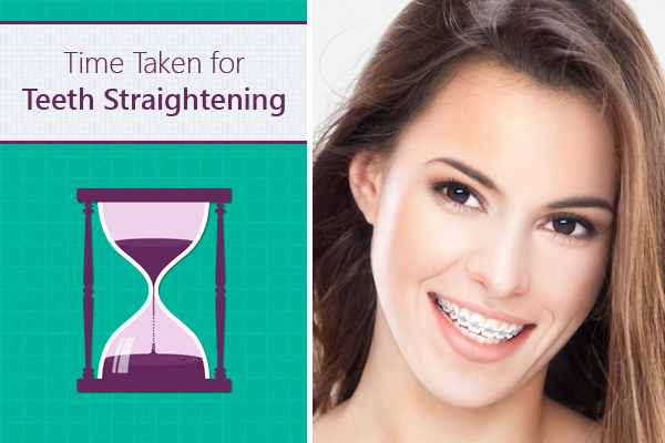 Time Required for Teeth Straightening