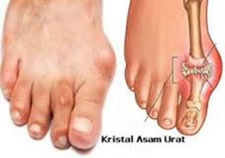 cek asam urat apa perlu puasa, cara mengobati asam urat paling ampuh, obat herbal yg ampuh buat asam urat, penyebab gout asam urat, obat asam urat tradisional yang mujarab, obat asam urat alami paling ampuh, asam urat makan kubis, komplikasi asam urat dan kolesterol, obat paling ampuh mengatasi asam urat, cuka apel menurunkan asam urat, tentang asam urat dan pantangannya, obat asam urat alami tanpa bahan kimia, larangan makanan bagi penderita asam urat dan kolesterol, tumbuhan obat sakit asam urat, penyakit asam urat dan obat tradisionalnya, asam urat seledri, asam urat pergelangan kaki, faktor resiko penyakit asam urat, apakah penyakit asam urat bisa sembuh total, kadar asam urat normal yaitu, www.penyebab asam urat tinggi, cara penyembuhan total asam urat, obat asam urat di jempol tangan, obat alami asam urat atau rematik, normal asam urat laki2 dan perempuan, cara mengobati asam urat yang alami, asam urat untuk wanita, cara menyembuhkan asam urat dengan semut jepang, buah-buahan untuk obat asam urat, cara menghilangkan rasa nyeri akibat asam urat 