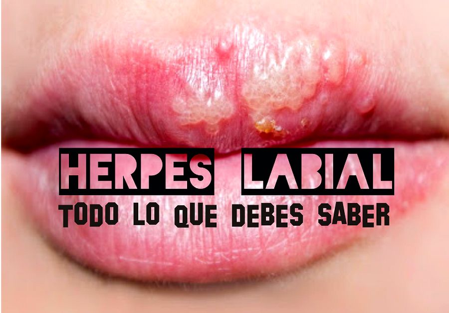 HERPES LABIAL: Todo lo que debes saber - OdontoFarma