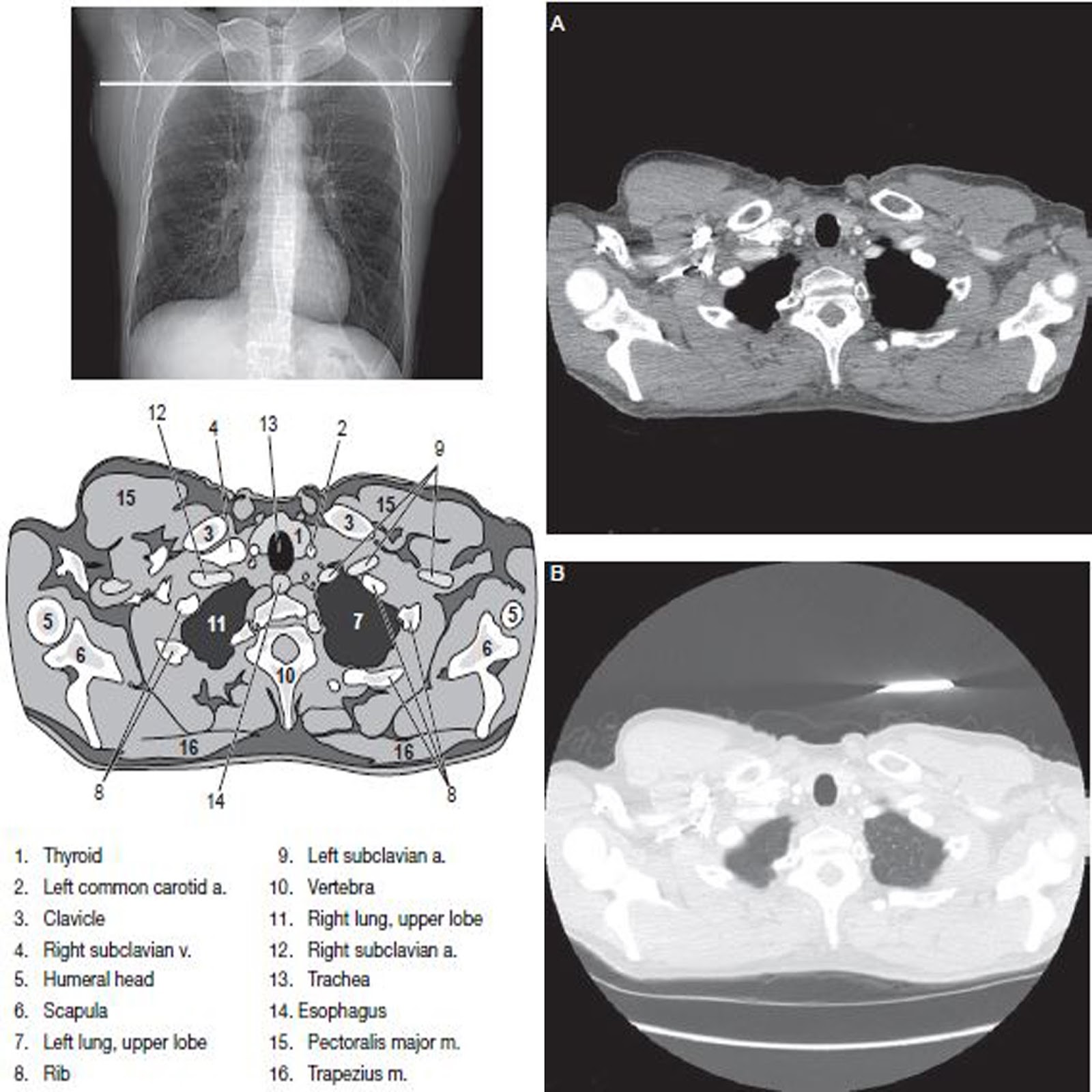 Chest Ct Scan Imaging Radtechonduty