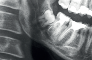 Lower dental nerve injury