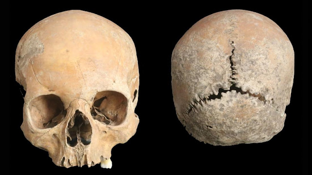 Anglo-Saxon girl had her nose and lips cut off as punishment, shows skull