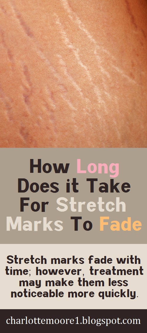 How Long Does it Take For Stretch Marks To Fade? Charlotte Moore