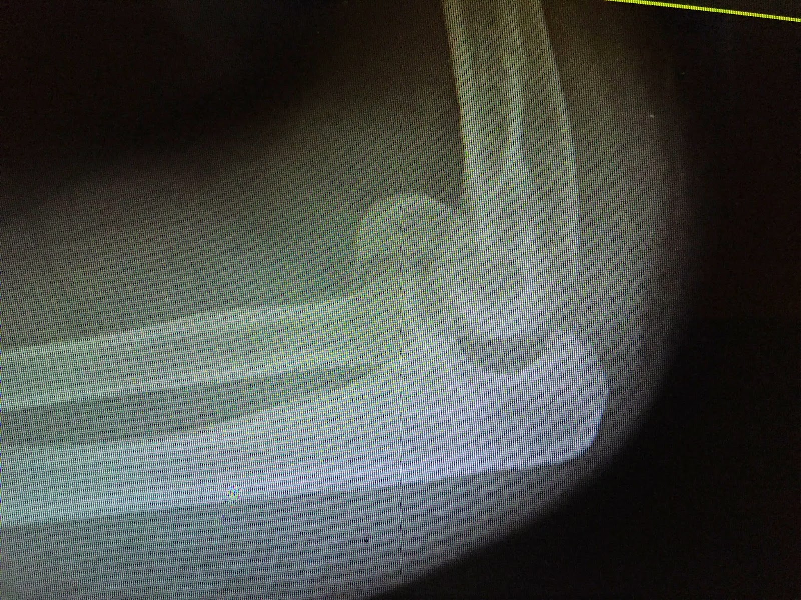 Shoulder and Elbow Surgery Shear fractures of the capitellum.