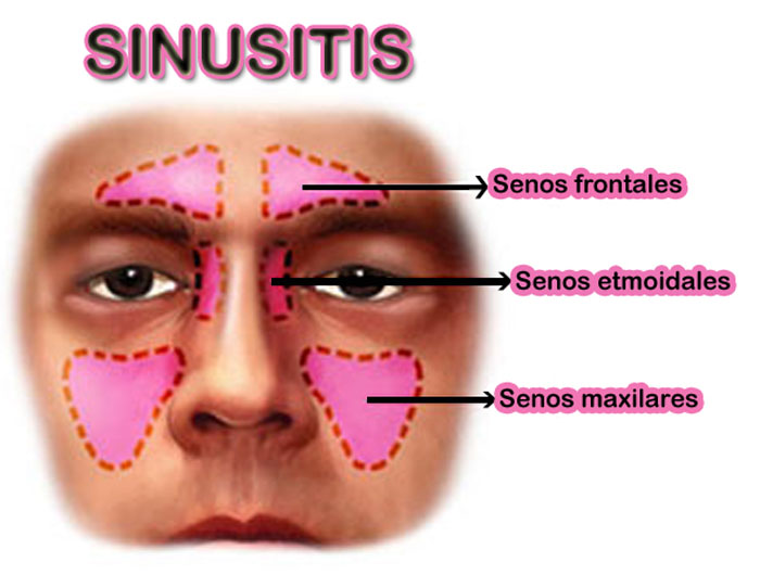 Sinusitis