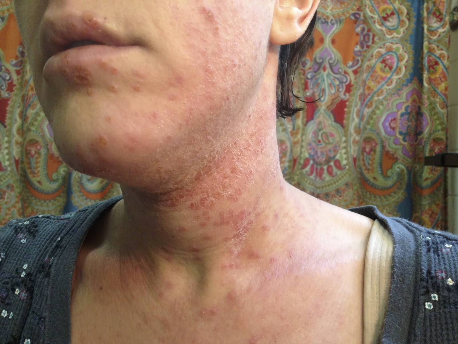 My journey with itchy skin. Remember that one time Eczema Herpeticum