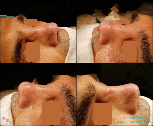 Male Rhinoplasty,Revision Rhinoplasty Operation With Rib Cartilage,Tertiary Revision Nose Aesthetic Surgery,Tertiary Revision Nose Job in Istanbul,