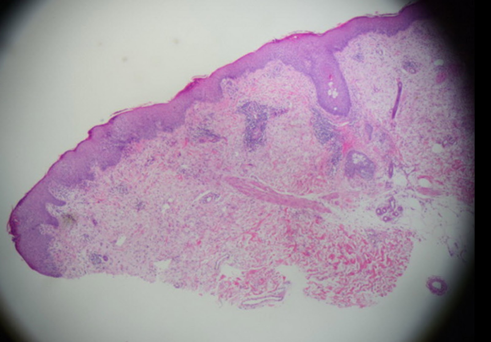 Dermatopathology Made Simple Inflammatory Skin Biopsies and the