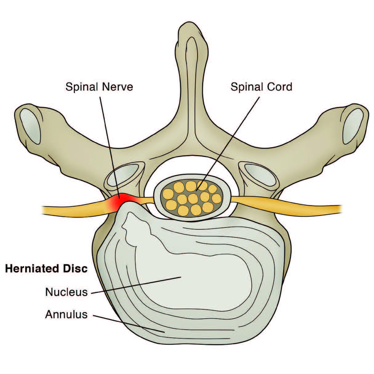 Lumbar Disc Herniation, Massage and Chiropractic