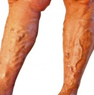 Mau masuk Tentara Tapi kaki varises ? Saya punya solusinya