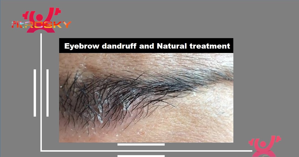 Eyebrow Dandruff and Natural Treatment fitROSKY