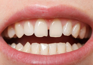 What causes Gap between Front Teeth