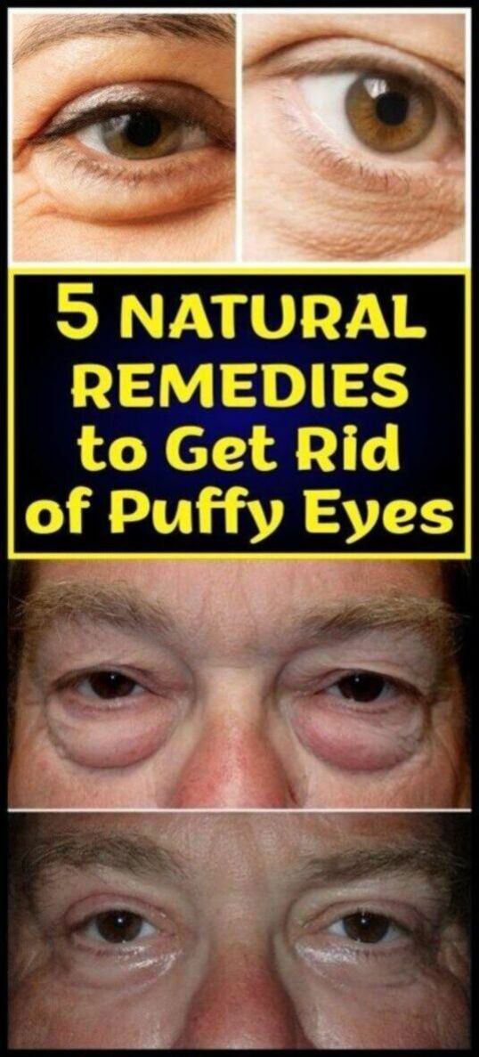 5 Natural And Effective Ways To Get Rid Of Puffy Eyes, And A Few Other