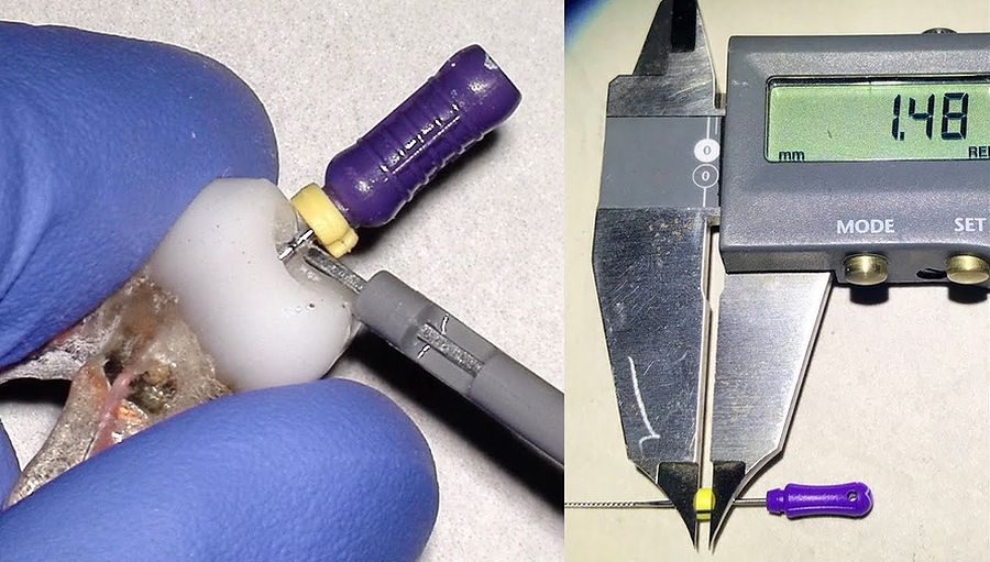 ENDODONTICS Root Canal File Rubber Stops 3 Simple Tips