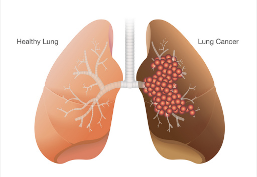  Lung cancer