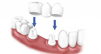 Cầu răng có quy trình như thế nào?