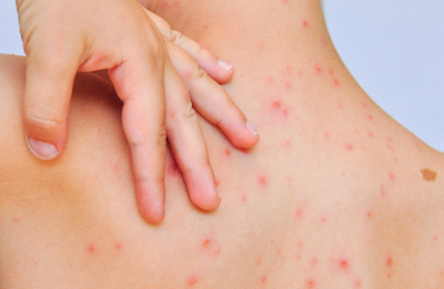 Gejala Alergi Pada Kulit yang Disebabkan Oleh Beberapa Faktor