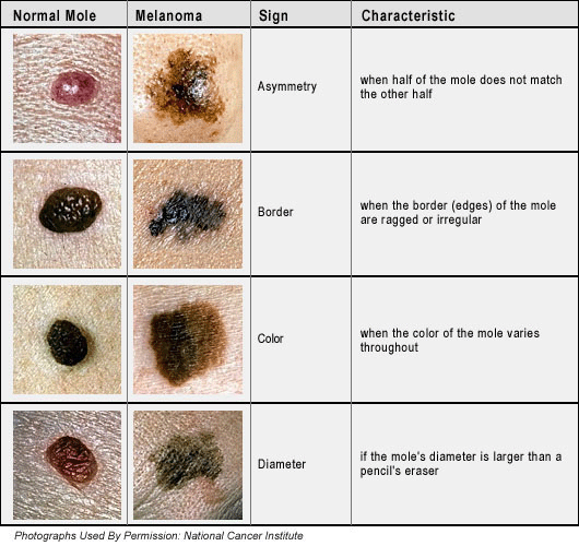 Black Moles On The Body 110