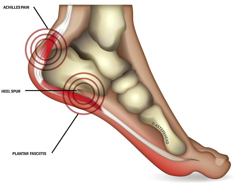 How To Treat Heel Pain how-to-treat-heel-pain