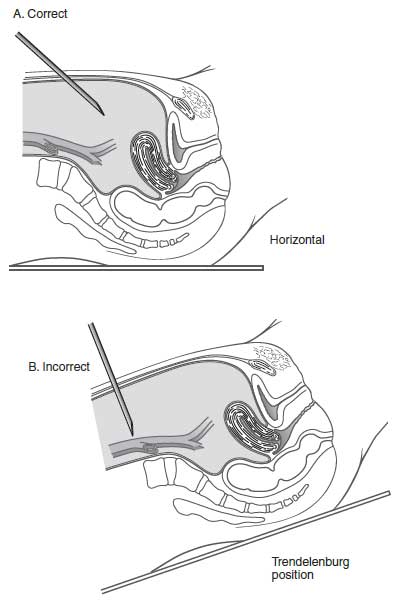 Laparoscopic Vascular Complications