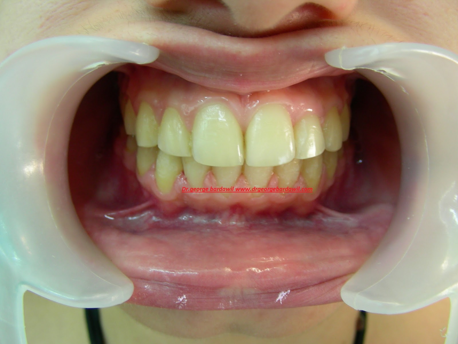 E. BardawilOrthodontistInvisalign Diamond level Anterior