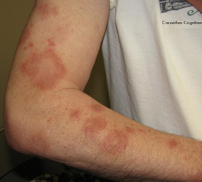 Pityriasis Rosea - Treatment - NHS Choices