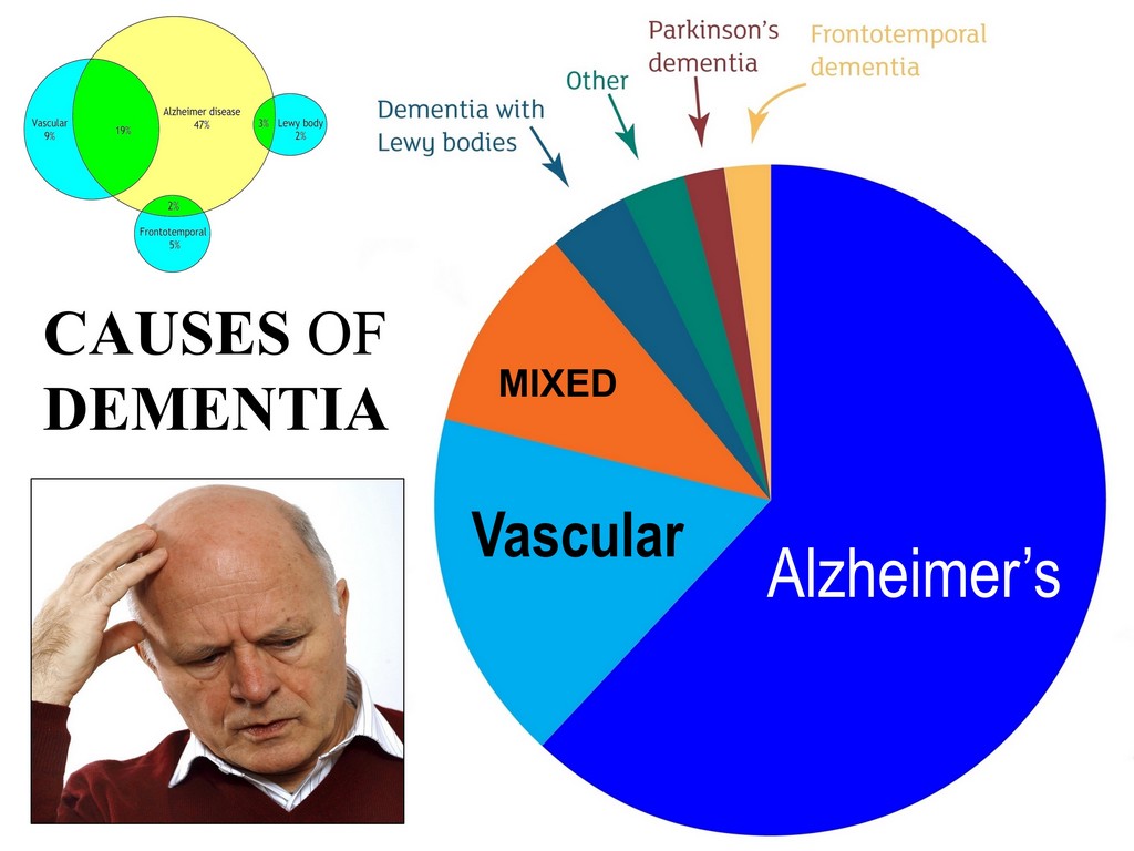 Dementia caused by Parkinson's disease Alzheimer’s