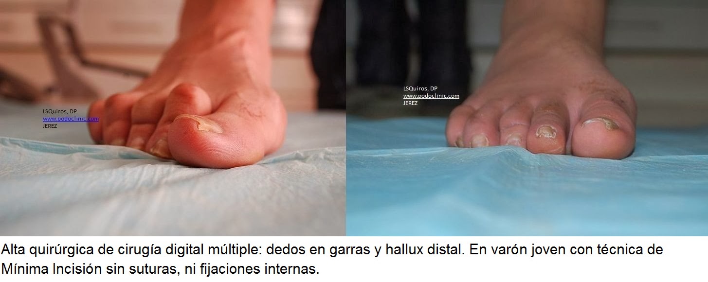 Blog de Quiros El mejor blog de podología. Queratoma