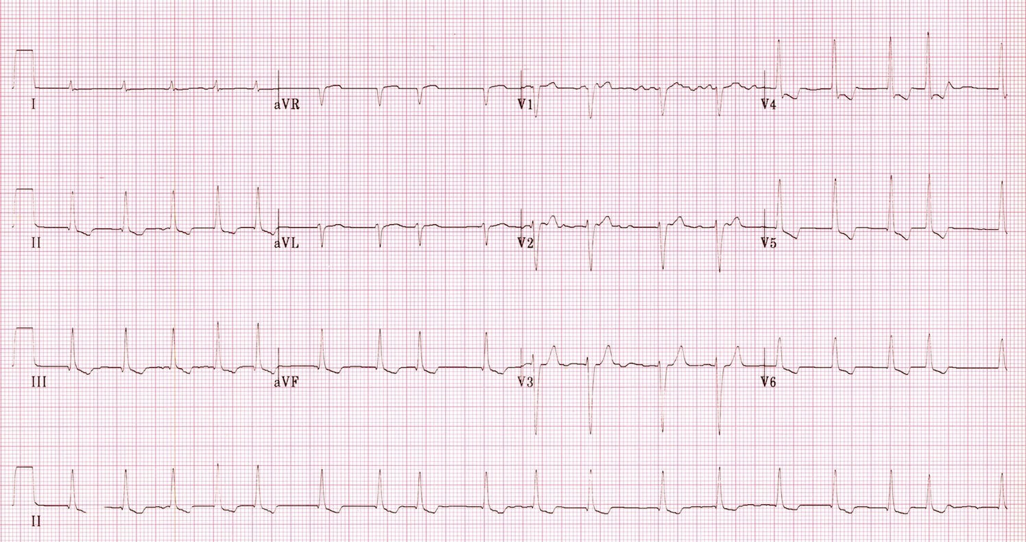 Digitalis toxicity clinical picture,risk factors and treatment