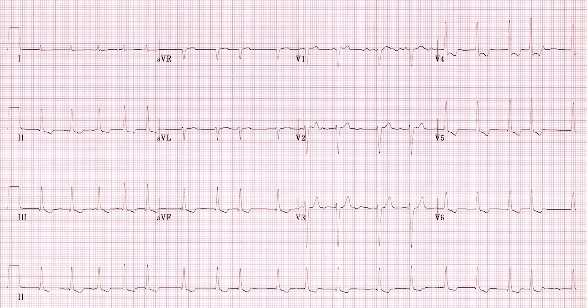 Digitalis toxicity clinical picture,risk factors and treatment