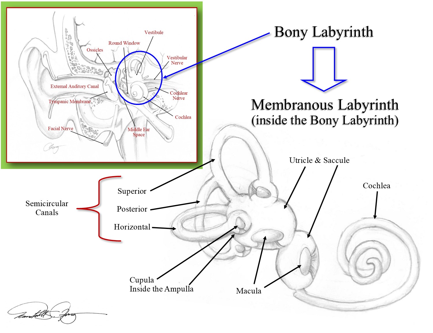 Dizziness Labyrinthitis
