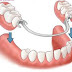 Trồng răng giả có nên cấy ghép xương hàm không