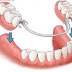 Trồng răng giả có nên cấy ghép xương hàm không