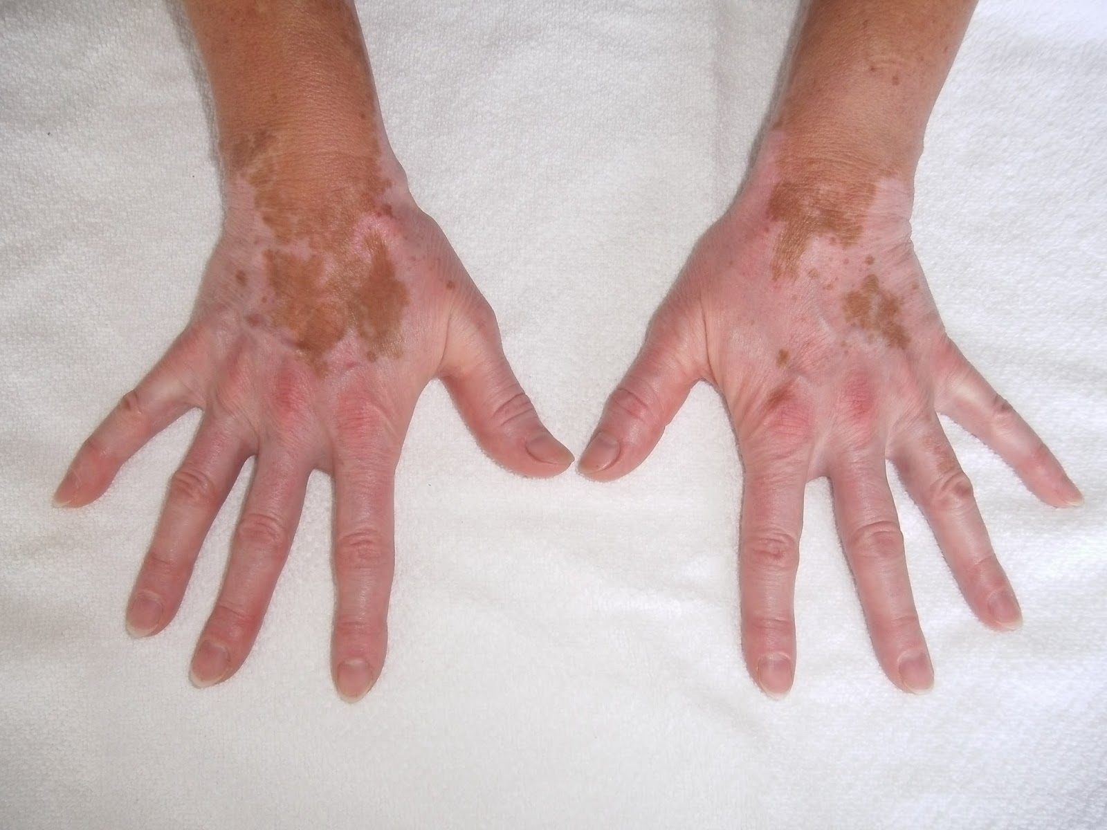 Rheumatologe Vitiligo in a Patient with Rheumatoid Arthritis under Methotrexate