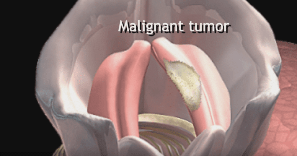 Cancer larynx: causes, symptoms, stages, diagnosis, treatment
