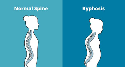 KYPHOSIS DISORDERS