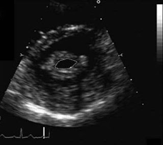 EAE/ASE Guidelines for the Diagnosis of Mitral Stenosis