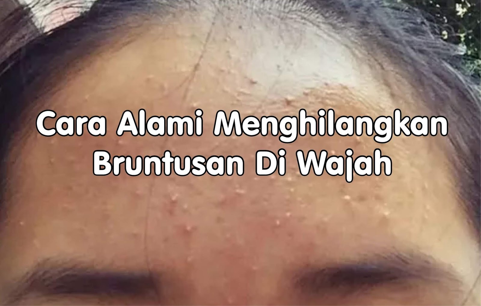 √ Cara Alami Menghilangkan Bruntusan Di Wajah